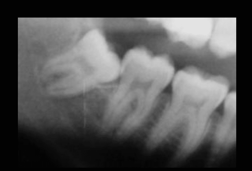 Parestesia, dente del giudizio e nervo mandibolare Studio Dentistico Prof. Checchi Dentista