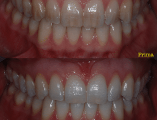 Sbiancamento denti prima e dopo