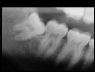 Ortodonzia estrattiva: il dente del giudizio viene allontanato con tecnica ortodontica dal nervo alveolare inferiore