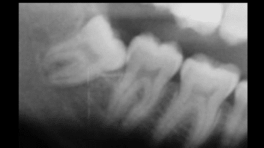 Ortodonzia estrattiva: il dente del giudizio viene allontanato con tecnica ortodontica dal nervo alveolare inferiore