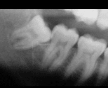 Ortodonzia estrattiva: il dente del giudizio viene allontanato con tecnica ortodontica dal nervo alveolare inferiore