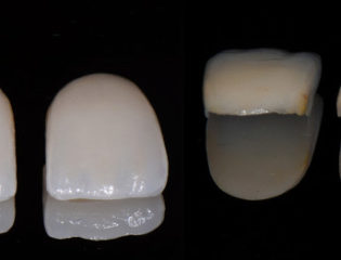 Faccette dentali