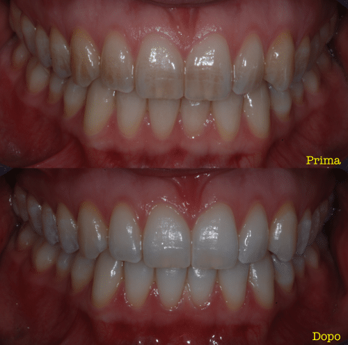 Sbiancamento denti prima e dopo