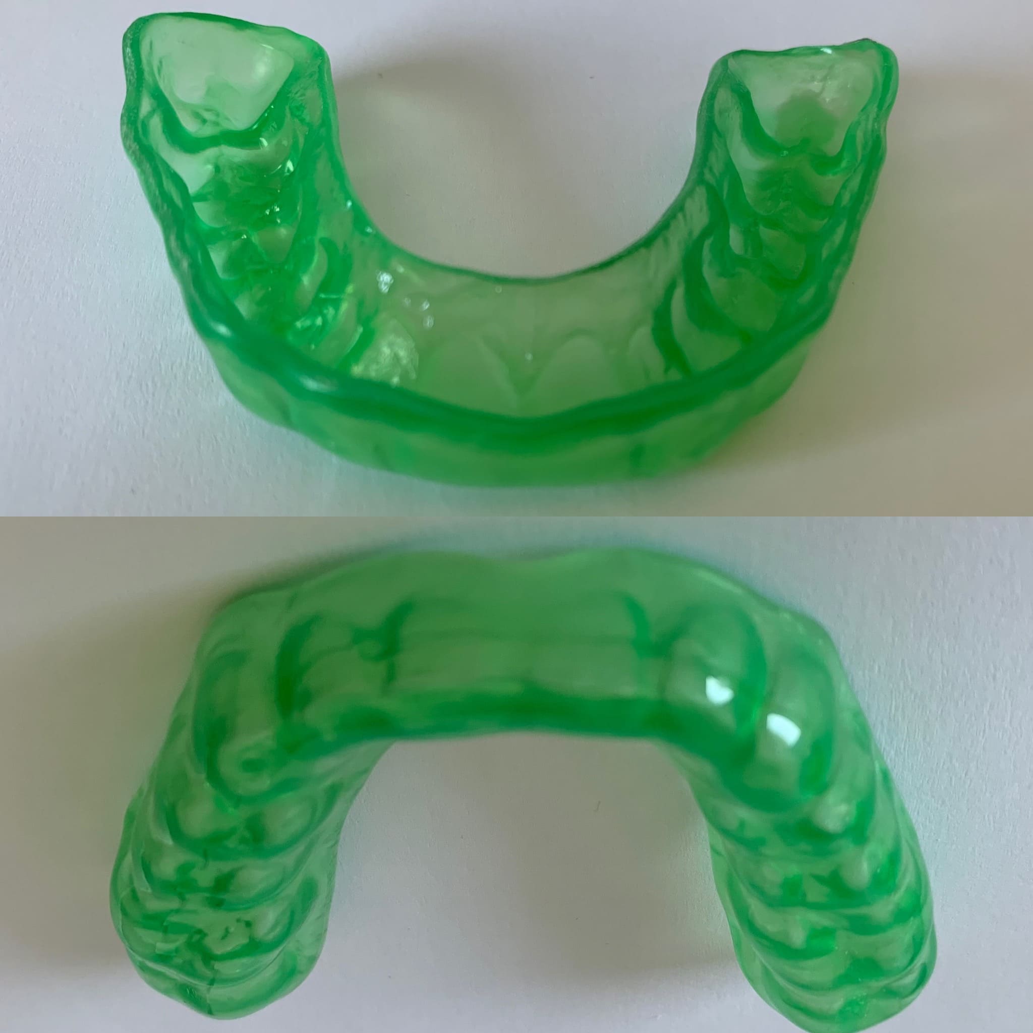 Paradenti o bite arcata superiore rigido esternamente e morbido internamente a contatto con la gengiva, realizzato con erkoloc-pro 3mm, con colorazioni disponibili in blu, verde o trasparente