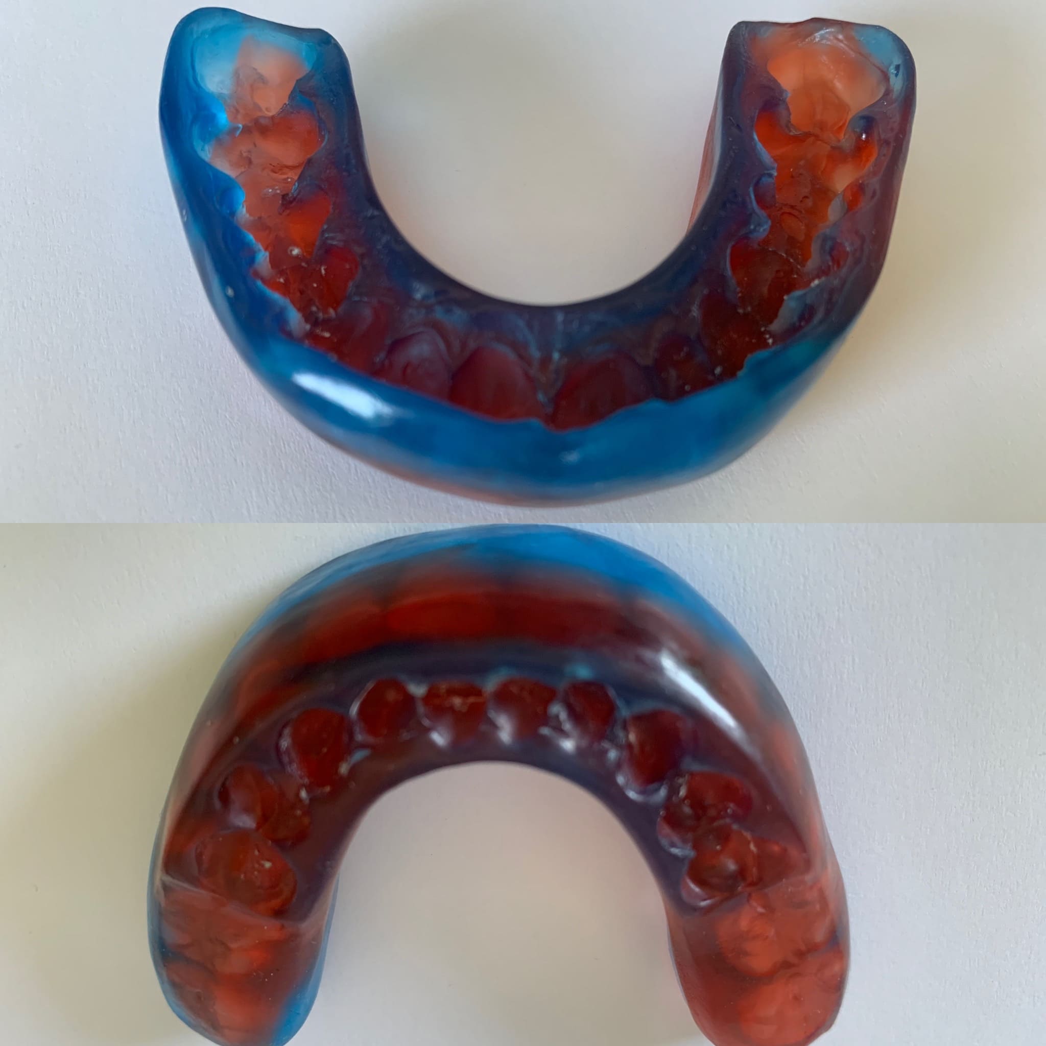 Paradenti o bite più complesso ancorato all’arcata superiore e inferiore, realizzato in silicone “corflex” previa modellazione in cera, messa in muffola e stampaggio a iniezione del materiale, disponibile in diverse colorazioni. Può essere utilizzato dai pugili o in ambito odontoiatrico-ortodontico come posizionatore finale.