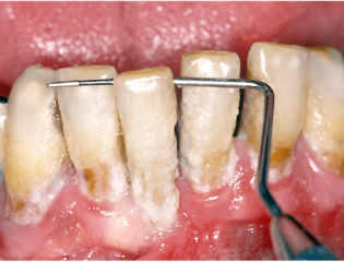 Piorrea e parodontite quadro avanzato