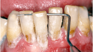 Piorrea e parodontite quadro avanzato