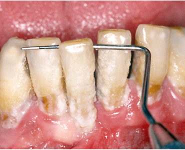 Piorrea e parodontite quadro avanzato