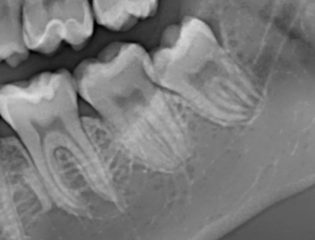 Immagini di un dente del giudizio in contiguità con il canale mandibolare