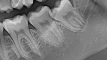 Immagini di un dente del giudizio in contiguità con il canale mandibolare
