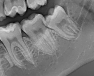 Immagini di un dente del giudizio in contiguità con il canale mandibolare