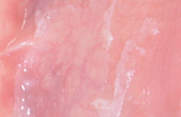 Reazione-allergica-da-collutorio-o-da-dentifricio