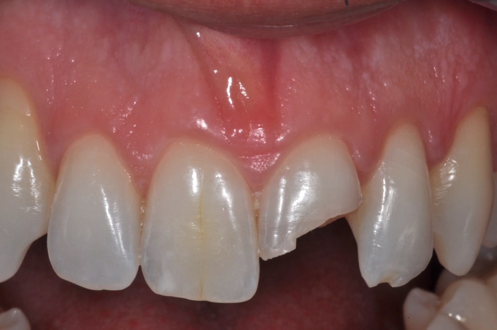 Rilevatore Di Frattura Dei Denti Dentali Danni ... - Aliexpress - Foto 12