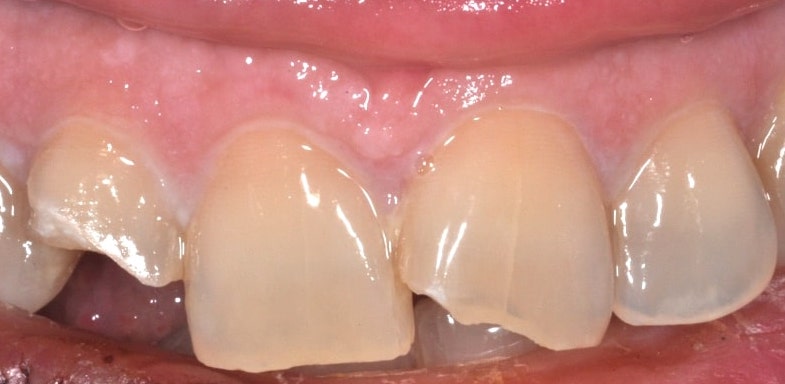 Ricotruzione resina denti frattura coronale 3a