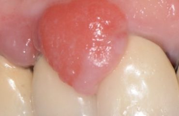 epulide
