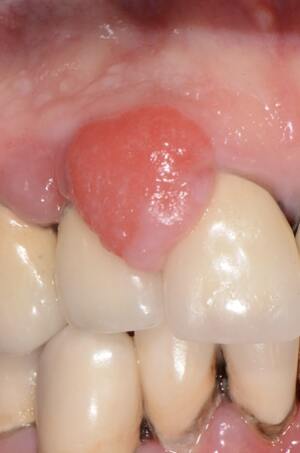 epulide tra gli elementi dentari antero superiori