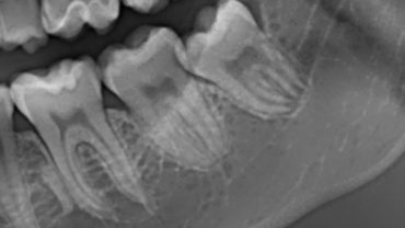 Terzo molare inferiore sinistro a contatto con il canale mandibolare