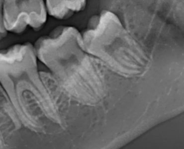 Terzo molare inferiore sinistro a contatto con il canale mandibolare