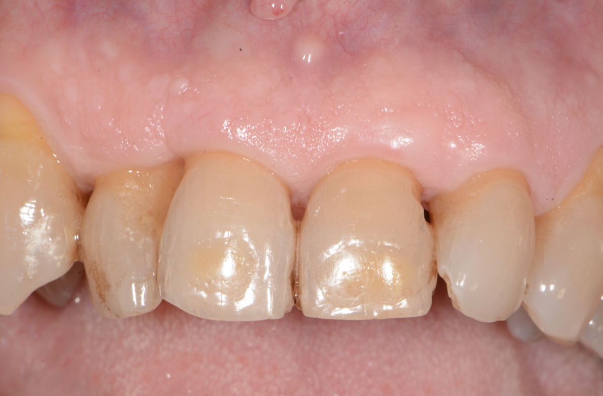 Epulide bilobata gengive