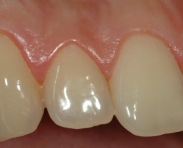 Immagine clinica di gengive infiammate. La terapia causale rappresenta il primo passo per controllare l’infiammazione