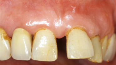 parodontite piorrea