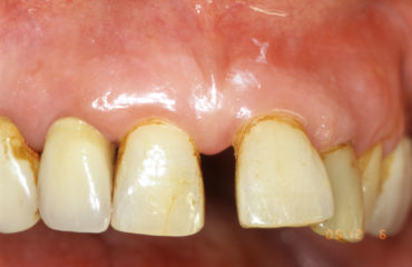parodontite piorrea