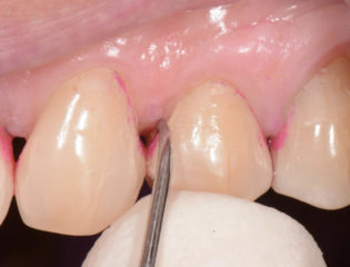 punta di una curette