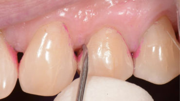 punta di una curette