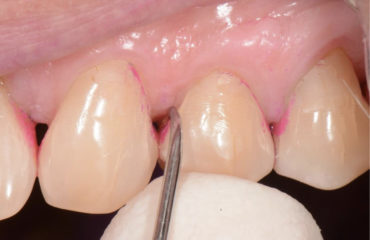 punta di una curette