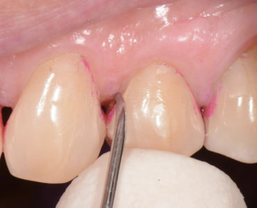 punta di una curette